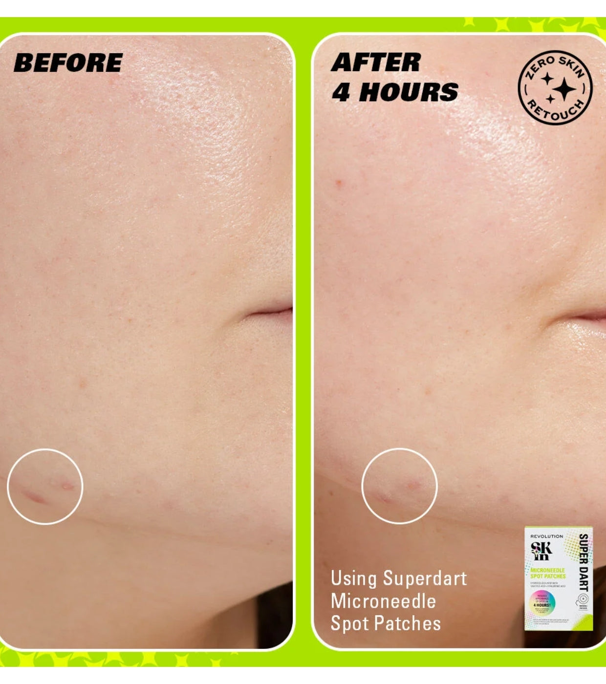 Revolution Skin - Patches de espinhas com microagulhas Super Dart